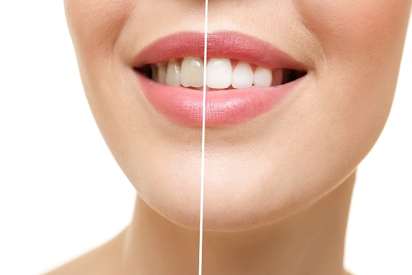 Aftercare Tips: In Office Teeth Whitening