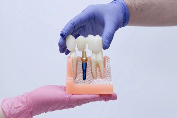 A Snapshot Of The Four Types Of Dental Bridges