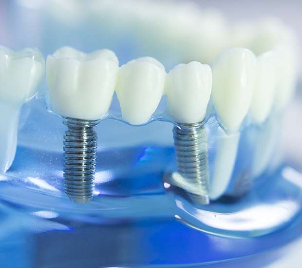 dental implants ashburn va