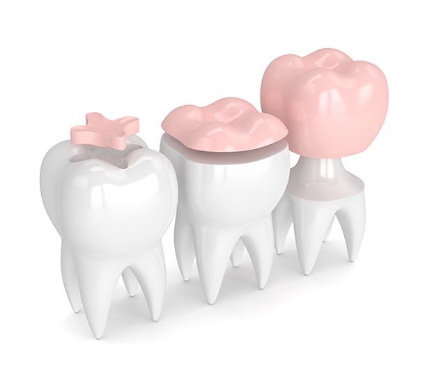 Sylva Dental Inlays and Onlays