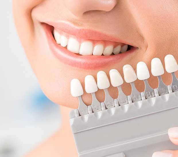 Sylva Dental Veneers and Dental Laminates